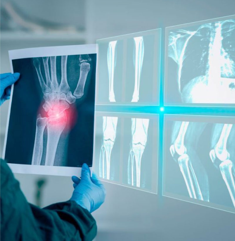 Tratamiento de fracturas en Guayaquil